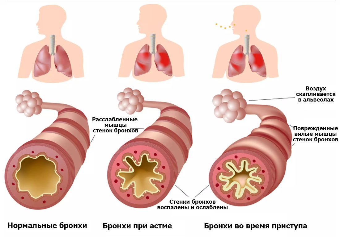 Докладно про бронхіальній астмі симптоми лікування заходи профілактики та відстрочені ускладнення