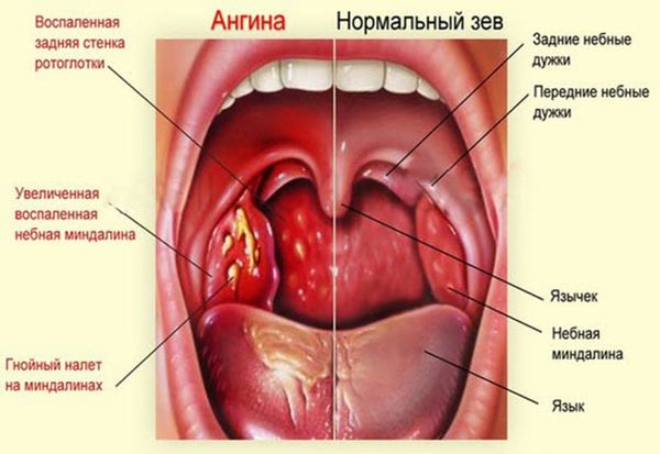 Дозволяється Тонзилгон при вагітності, як його застосовувати і чим можна замінити? Тонзилгон при вагітності інструкція по застосуванню