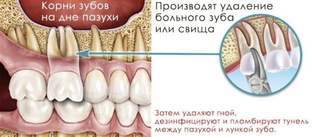 ДУБЛІКАТ Однотогенный гайморит причини появи та методи лікування