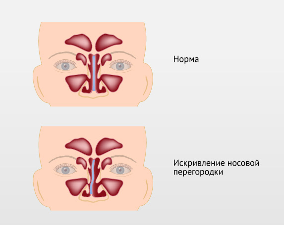 Двосторонній гайморит лікування у дитини і дорослого