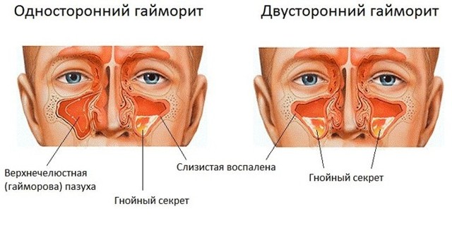 Двосторонній гайморит — Поради отоларинголога