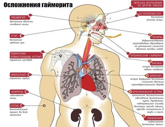 Двосторонній гайморит — Поради отоларинголога