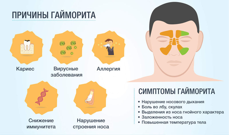 Двосторонній гайморит — Поради отоларинголога