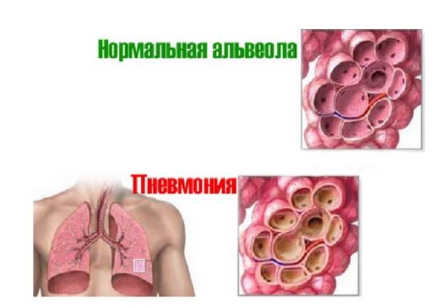 Двостороння пневмонія у дорослого причини та підходи до лікування