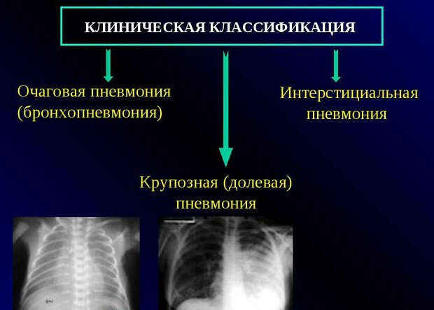Двостороння пневмонія у дорослого причини та підходи до лікування