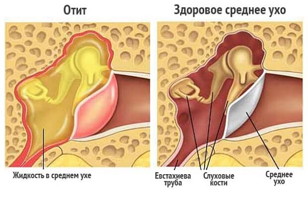 Дзвін у вухах, причини і лікування