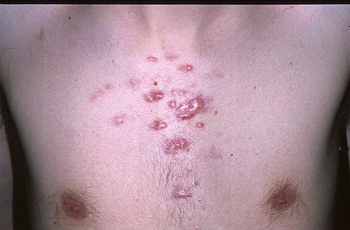 Ефективні процедури щодо позбавлення від рубців на шкірі