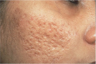 Ефективні процедури щодо позбавлення від рубців на шкірі