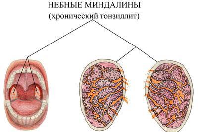 Ефективність Мірамістину при ангіні у дорослих і дітей
