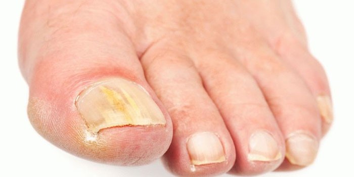 Ефективне лікування грибка нігтів на ногах народними засобами в домашніх умовах