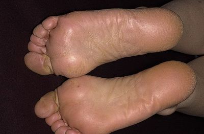 Ефективне лікування грибка нігтів на ногах народними засобами в домашніх умовах