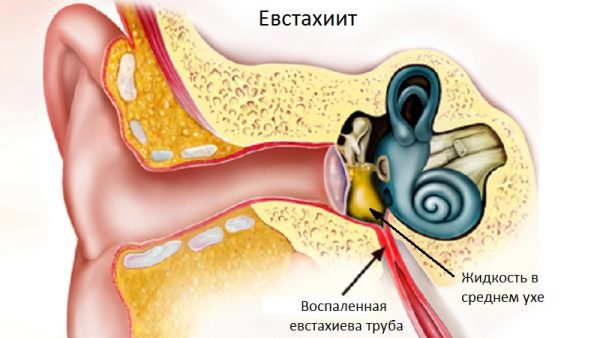 Ефективне лікування тубоотіта в домашніх умовах Ефективне лікування тубоотіта в домашніх умовах