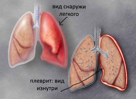 Ексудативний плеврит: причини, симптоми і лікування