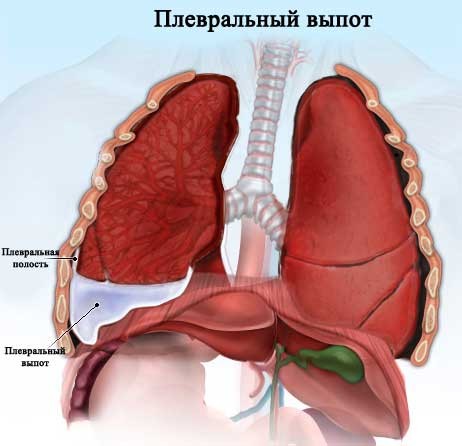 Ексудативний плеврит: причини, симптоми і лікування