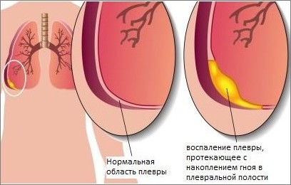 Ексудативний плеврит: причини, симптоми і лікування