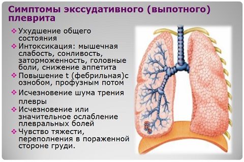 Ексудативний плеврит: причини, симптоми і лікування