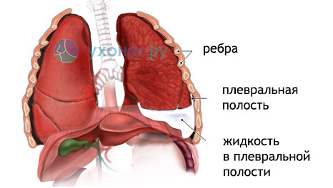 Ексудативний (випотной) плеврит: особливості, ознаки, лікування