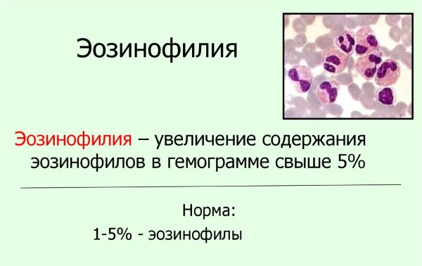 Еозинофіли підвищені відносно норми: причини патології, як знизити