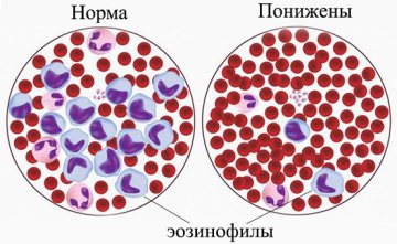 Еозинофіли підвищені відносно норми: причини патології, як знизити