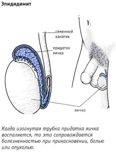 Епідидиміт — симптоми і види захворювання, діагностика та лікування