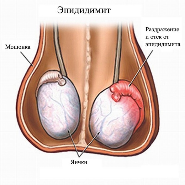 Епідидиміт — симптоми і види захворювання, діагностика та лікування