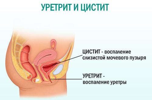 Епітелій плоский в сечі підвищений