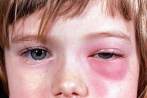 Етмоїдит причини симптоми і лікування у дорослих і дітей