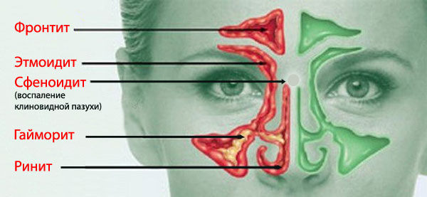 Етмоїдит причини симптоми і лікування у дорослих і дітей