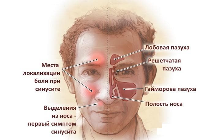 Етмоїдит – симптоми і лікування хвороби у людей, запалення