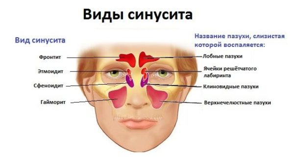 Етмоїдит – симптоми і лікування хвороби у людей, запалення
