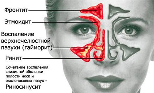 Етмоїдит: симптоми і лікування у дорослих