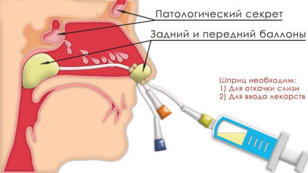 Етмоїдит: симптоми і лікування у дорослих