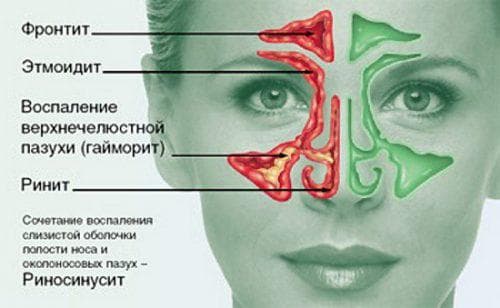 Етмоїдит – симптоми і лікування у дорослих 2019