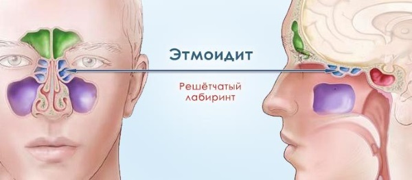 Етмоїдит: симптоми і лікування у дорослих