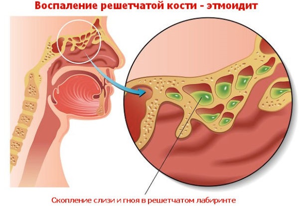 Етмоїдит: симптоми і лікування у дорослих