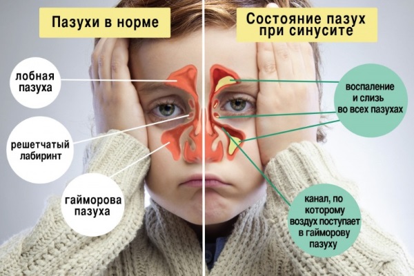 Етмоїдит: симптоми і лікування у дорослих