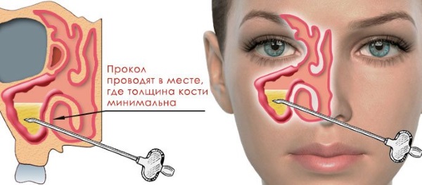 Етмоїдит: симптоми і лікування у дорослих