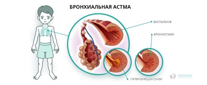 Еуфілін для інгаляцій в небулайзере: інструкція