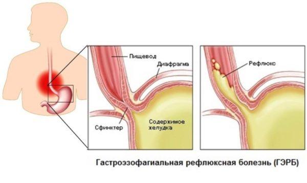 Езофагіт і трави лікування народними засобами