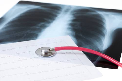 Фіброз легенів симптоми методи діагностики терапії та профілактики