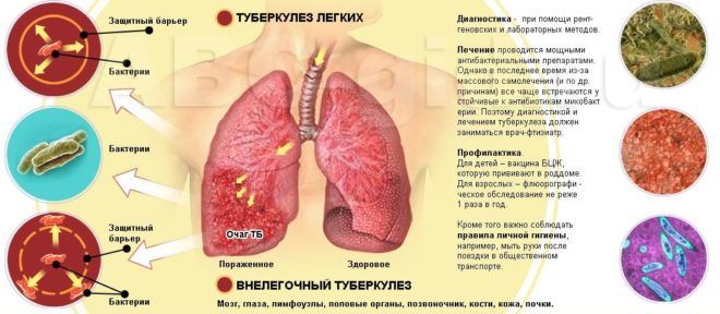 Фіброз легенів симптоми методи діагностики терапії та профілактики
