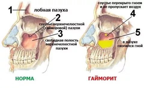 Фізіопроцедури при гаймориті: види процедур