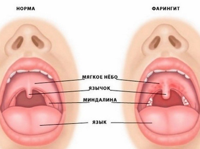 Фарингіт у дітей: симптоми, діагностика, лікування. Гострий фарингіт у дітей: особливості розвитку і різні способи лікування