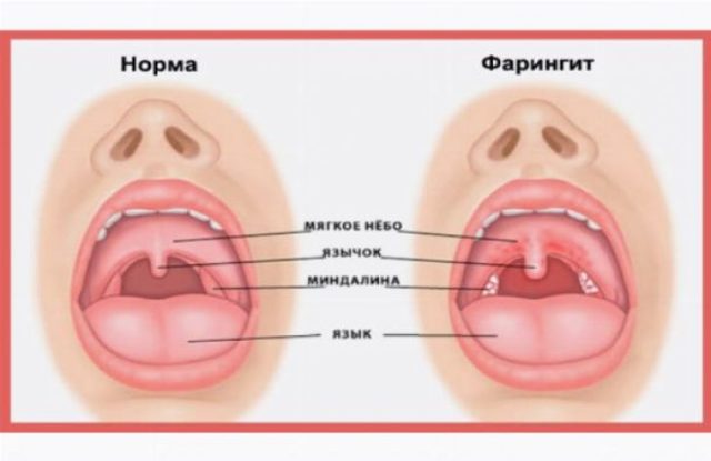 Фарингіт у дітей: симптоми, діагностика, лікування. Гострий фарингіт у дітей: особливості розвитку і різні способи лікування