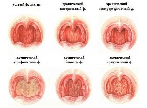 Фарингіт заразний чи ні для оточуючих: як передається. Чи передається фарингіт, заразний він чи ні? Гострий фарингіт спосіб передачі