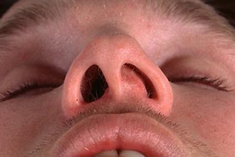 Фаринголарингит у дорослих як проявляється і методи його лікування