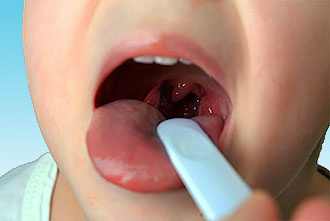 Фаринголарингит у дорослих як проявляється і методи його лікування