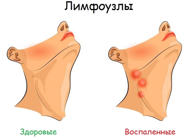 Фарингосепт відгуки інструкція по застосуванню. Інструкція по застосуванню Фарингосепта: від чого допомагає