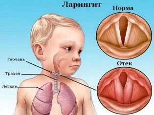 Флуімуціл – антибіотик ІТ: інструкція по застосуванню, ціна та відгуки. Як розводити для інгаляцій