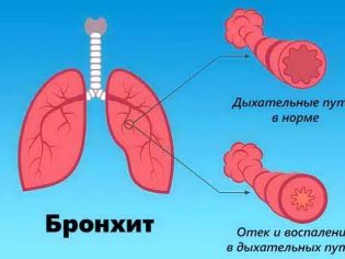 Флуімуціл – антибіотик ІТ: інструкція по застосуванню, ціна та відгуки. Як розводити для інгаляцій